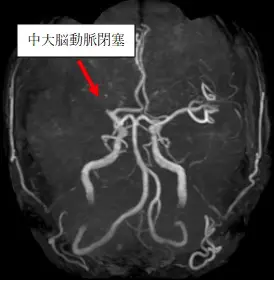 頭蓋内動脈ステントのすべて 頭蓋内動脈ステントのすべて: 留置場面のWEB動画付き/コイル併用