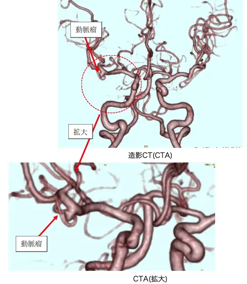 未破裂脳動脈瘤 | あらい和光市駅前 脳外科・神経内科