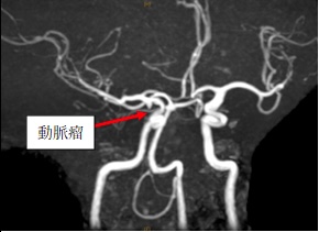 右内頸動脈瘤-後交通動脈瘤(Pcom) 