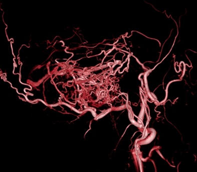 脳血管造影 3D
