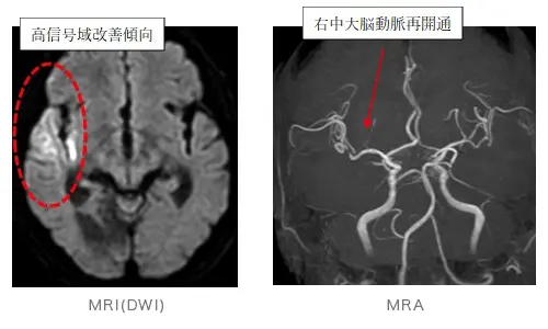 脳梗塞・一過性脳虚血発作 | あらい和光市駅前 脳外科・神経内科
