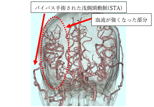 頸動脈狭窄症・頭蓋内動脈狭窄症/閉塞症 | あらい和光市駅前