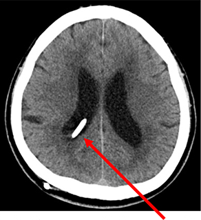 VP（脳室-腹腔）シャント術後CT：脳室チューブ